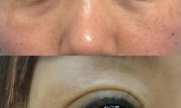 除眼袋手术多久恢复