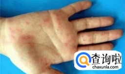 小儿常见皮疹如何区别