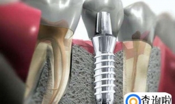 一看就能明白的镶牙全过程