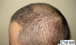 植发能不能一劳永逸