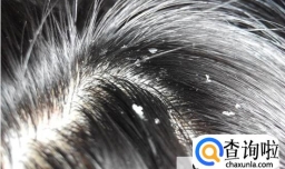 缺锌会长头皮屑吗