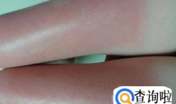 夏季皮肤晒伤的急救方法有哪些？