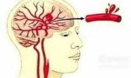 有哪些人容易患脑溢血