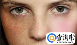 晒斑和雀斑的区别