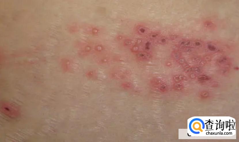 怎么诊断带状疱疹？