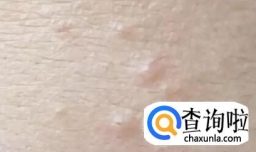 脸上的粉刺怎么去除最有效