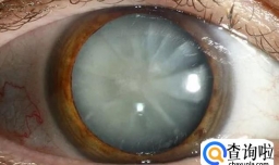 多晒太阳近视居然好了是真的吗