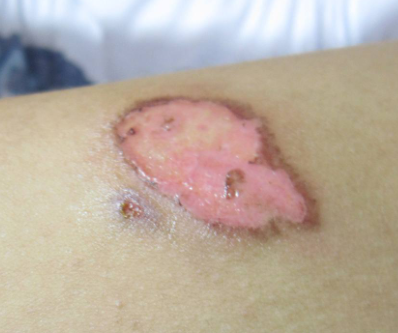 烫伤之后要注意点啥