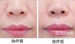 自体脂肪填充鼻唇沟价格多少钱？