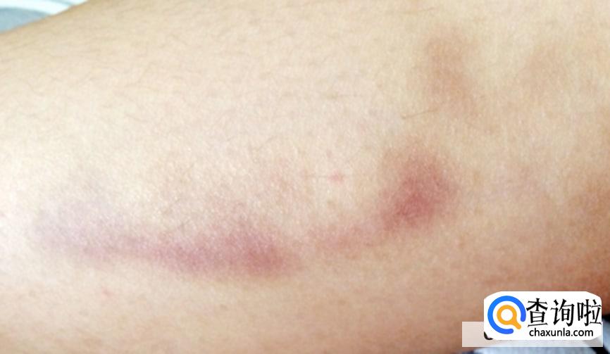 身上总是青一块紫一块什么原因