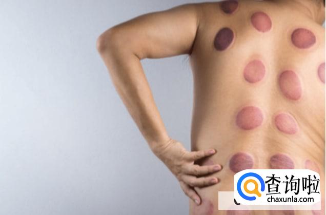 拔罐后多久能洗澡