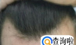 发际线是天生的吗？发际线怎么调整？