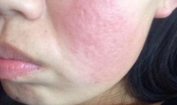 为什么脸一敷面膜就过敏