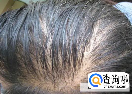如何预防脱发