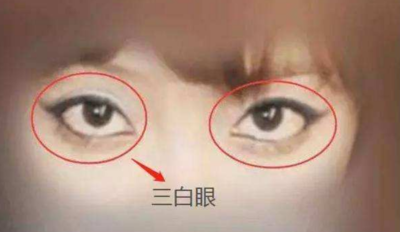 什么是三白眼
