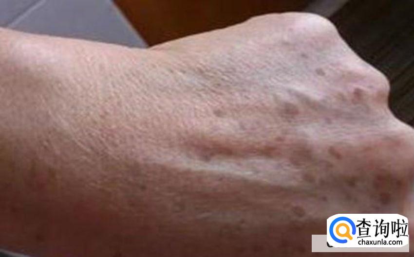 预防老年斑的最好方法