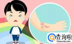 红皮病的临床症状有哪些