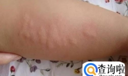 孩子得了过敏性荨麻疹怎么办