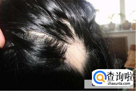 引起脱发的原因