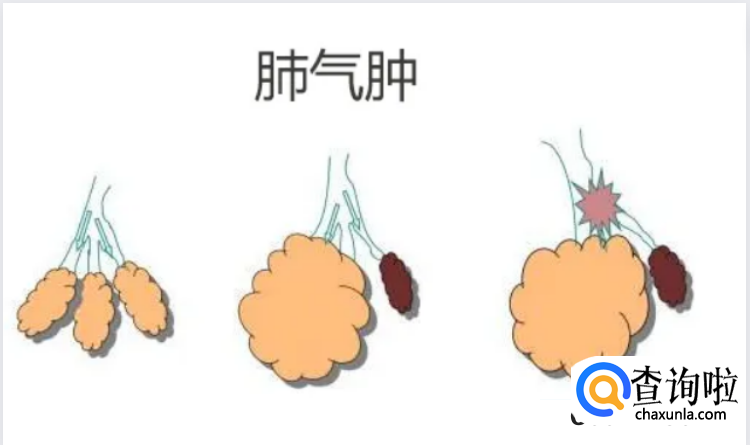 患有肺气肿的表现有哪些