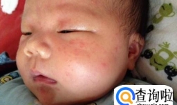 夏季宝宝起热痱子怎么办？