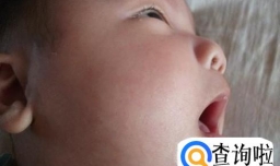 小孩总是流口水导致嘴周围湿疹