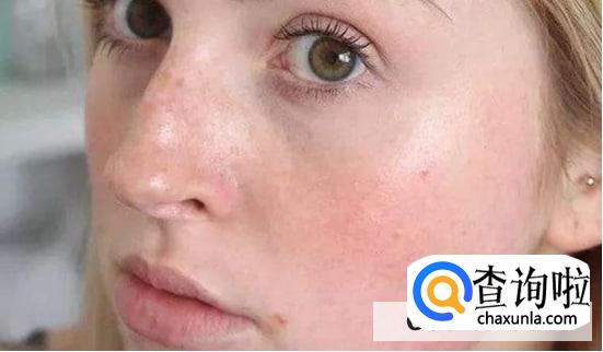 夏天皮肤出油怎么办