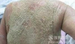 如何治疗红皮病