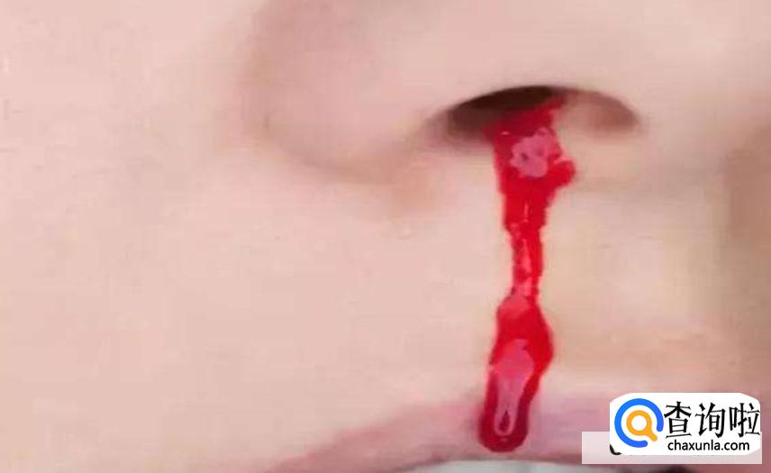 为什么会流鼻血,流鼻血的原因