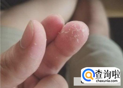 502弄到手上如何处理