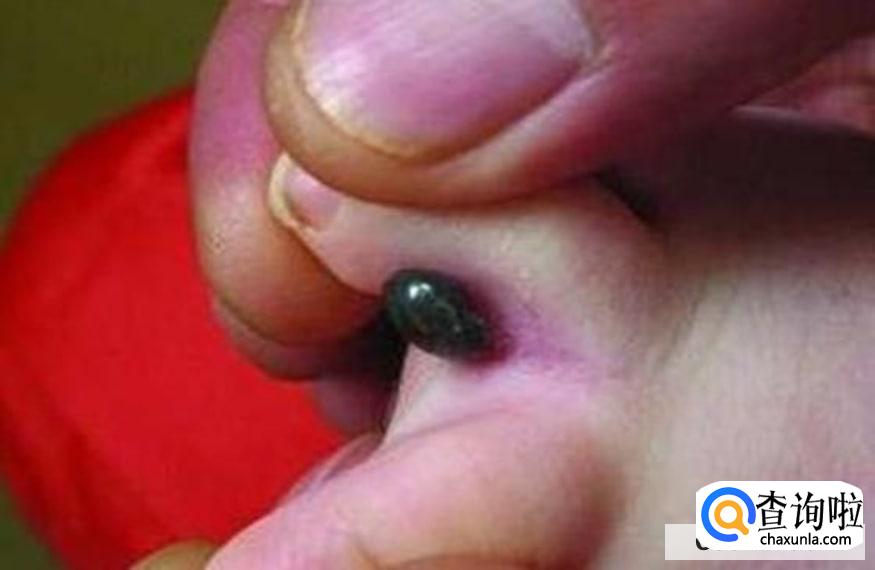 被蜱虫叮咬后怎么办？