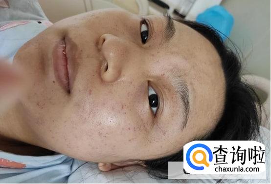 去痣多久可以洗脸