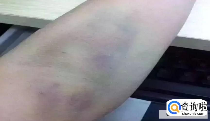 身上总是青一块紫一块什么原因