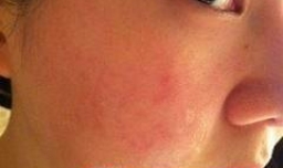 哪些情况下不能敷面膜