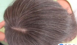 治疗白发的秘方
