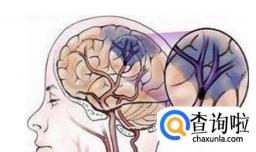 怎样科学预防脑梗塞？