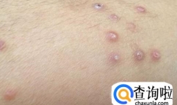 盐酸依匹斯治疗湿疹有效果吗