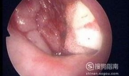 腺样体肥大我是这样给宝宝调理的