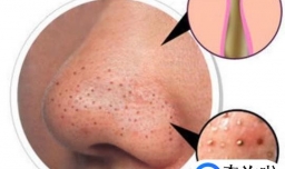 为什么脸上会有黑头呢？