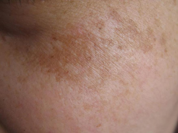 吃什么有助于淡化黄褐斑