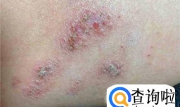 孕妇身上长湿疹怎么办