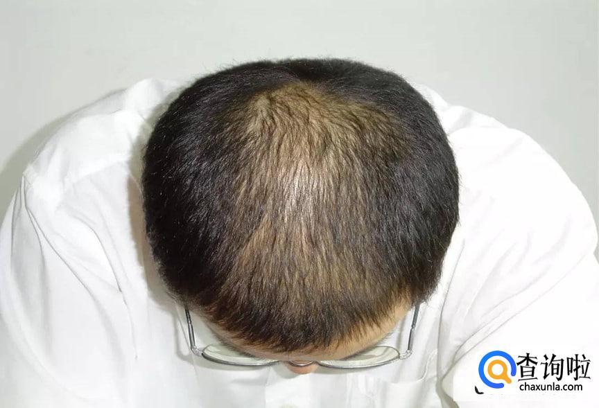30岁脱发要怎么调理