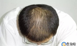 30岁脱发要怎么调理