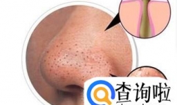 皮肤为什么会有黑头