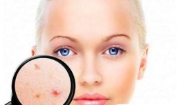 怎样去痘疤，几个去痘疤的民间小偏方