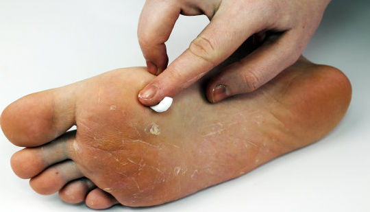 真菌感染怎么办