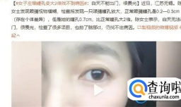女子左眼瞳孔变大2倍找不到病因 瞳孔为何会突然扩大