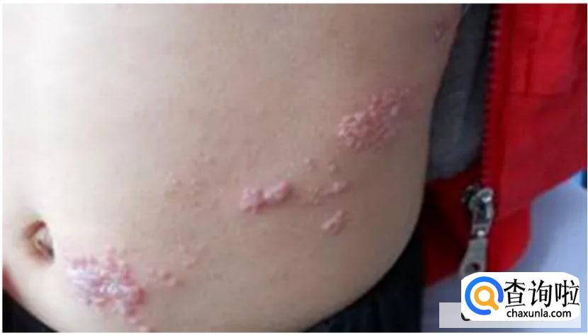 怎么诊断带状疱疹？