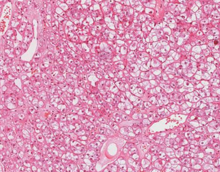 什么是嫌色细胞癌