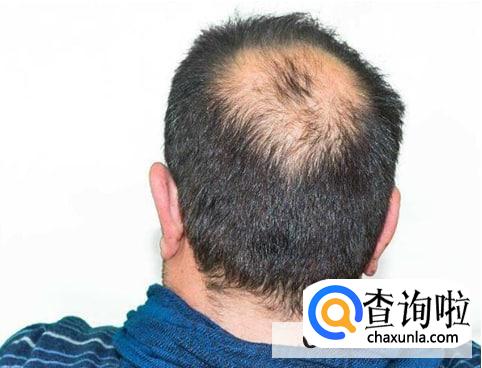 熬夜真的会秃头吗